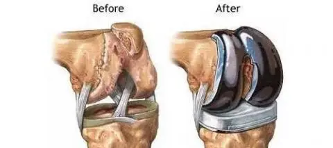 diz protezi ameliyatı nasıl olur